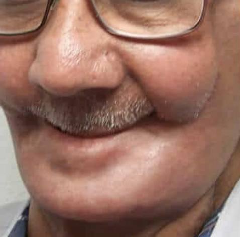 patient wearing osseointegration retained mandible prosthesis